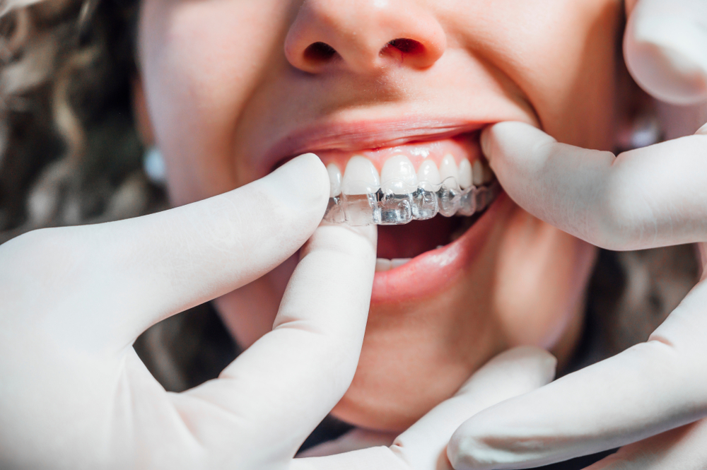 Invisalign express