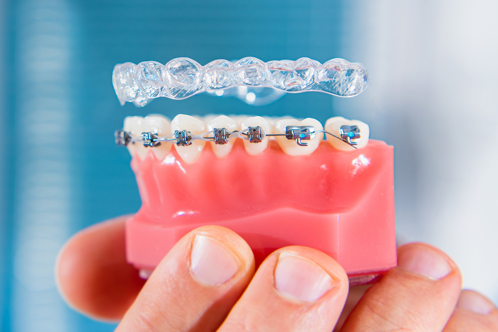 Teeth Alignment Dayton