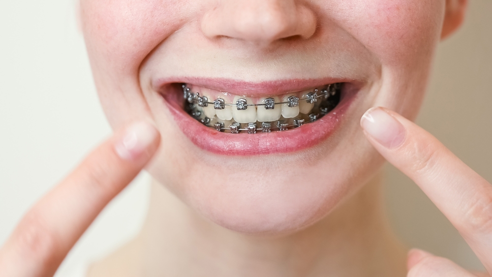 Traditional Braces in Dayton